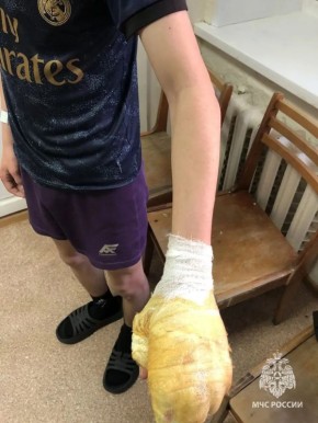 В Ижевске двое детей пострадали из-за взрыва пиротехники