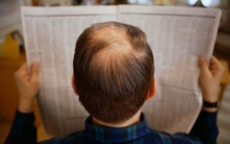 Как справиться с облысением: советы дерматолога